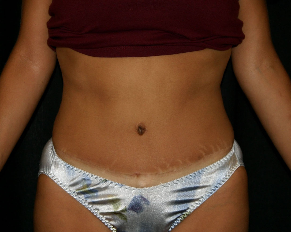 Liposculpture Los Angeles California