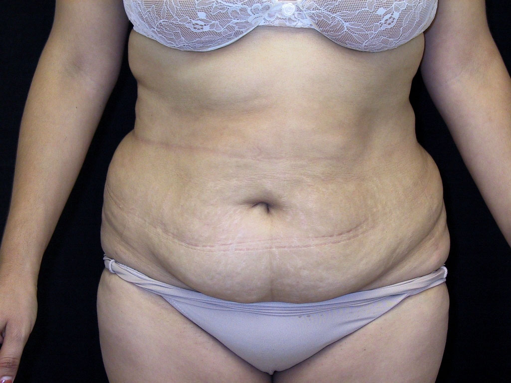 Liposculpture Los Angeles California