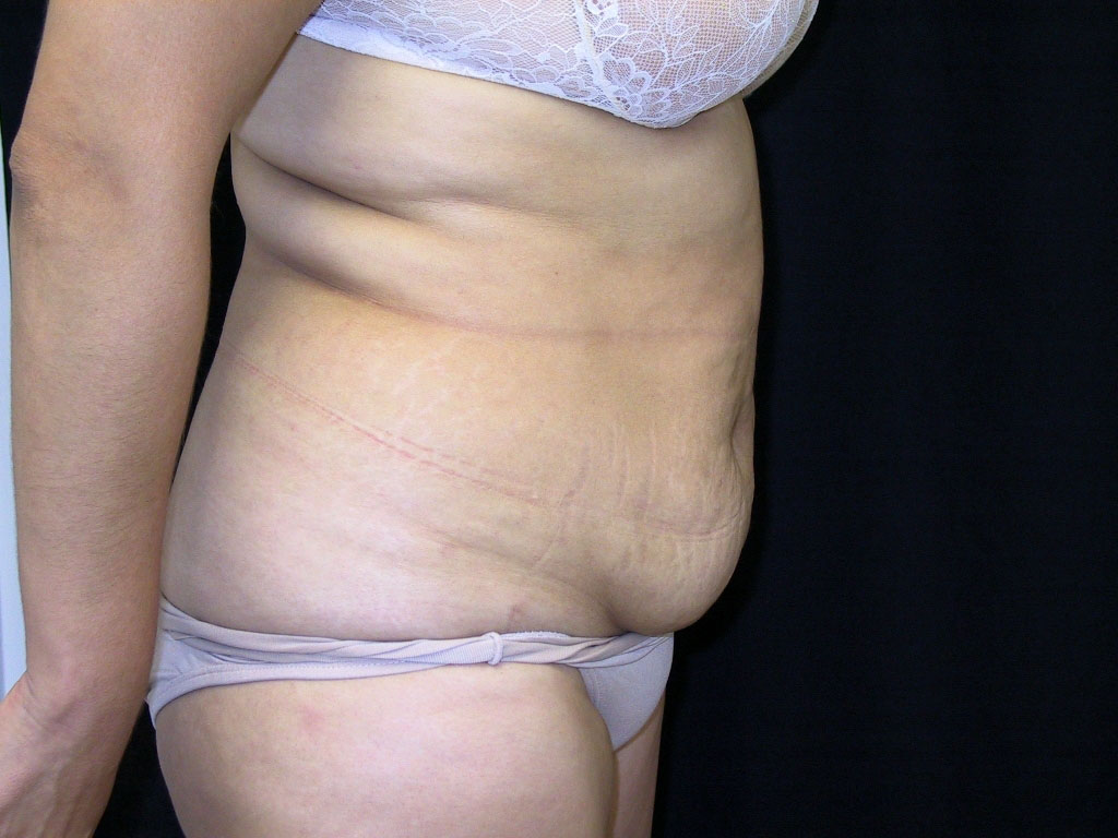 Liposculpture Los Angeles California
