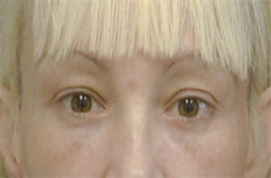 Blepharoplasty Los Angeles California