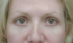 Blepharoplasty Los Angeles California