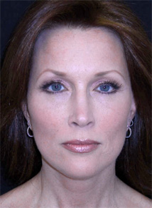 Facelift Los Angeles California