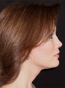 Facelift Los Angeles California