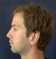 Rhinoplasty Los Angeles California