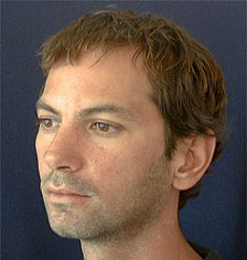 Rhinoplasty Los Angeles California