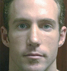 Rhinoplasty Los Angeles California