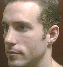 Rhinoplasty Los Angeles California