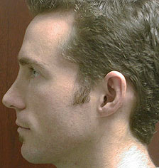 Rhinoplasty Los Angeles California