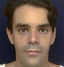 Rhinoplasty Los Angeles California