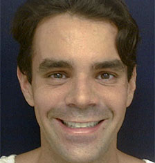 Rhinoplasty Los Angeles California