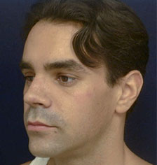 Rhinoplasty Los Angeles California