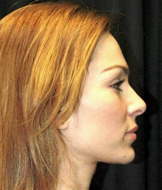 Rhinoplasty Los Angeles California