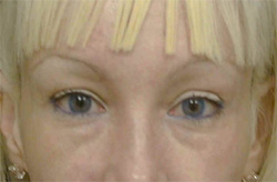 Blepharoplasty Los Angeles California