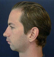 Rhinoplasty Los Angeles California