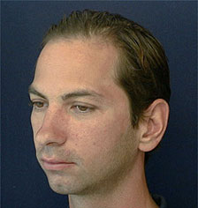 Rhinoplasty Los Angeles California