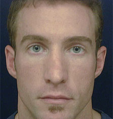 Rhinoplasty Los Angeles California