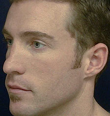 Rhinoplasty Los Angeles California