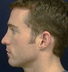 Rhinoplasty Los Angeles California