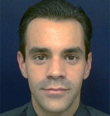 Rhinoplasty Los Angeles California