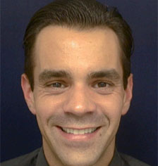 Rhinoplasty Los Angeles California