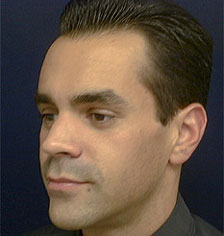 Rhinoplasty Los Angeles California