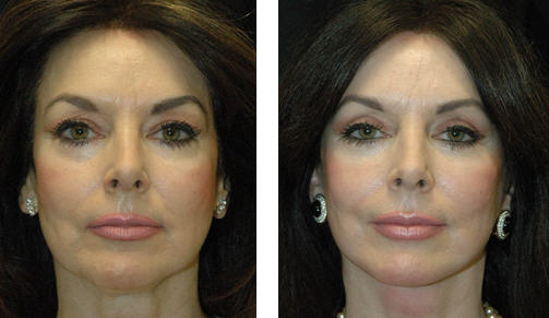 Patient before and after photo that underwent blepharoplasty Blepharoplasty Beverly Hills CA