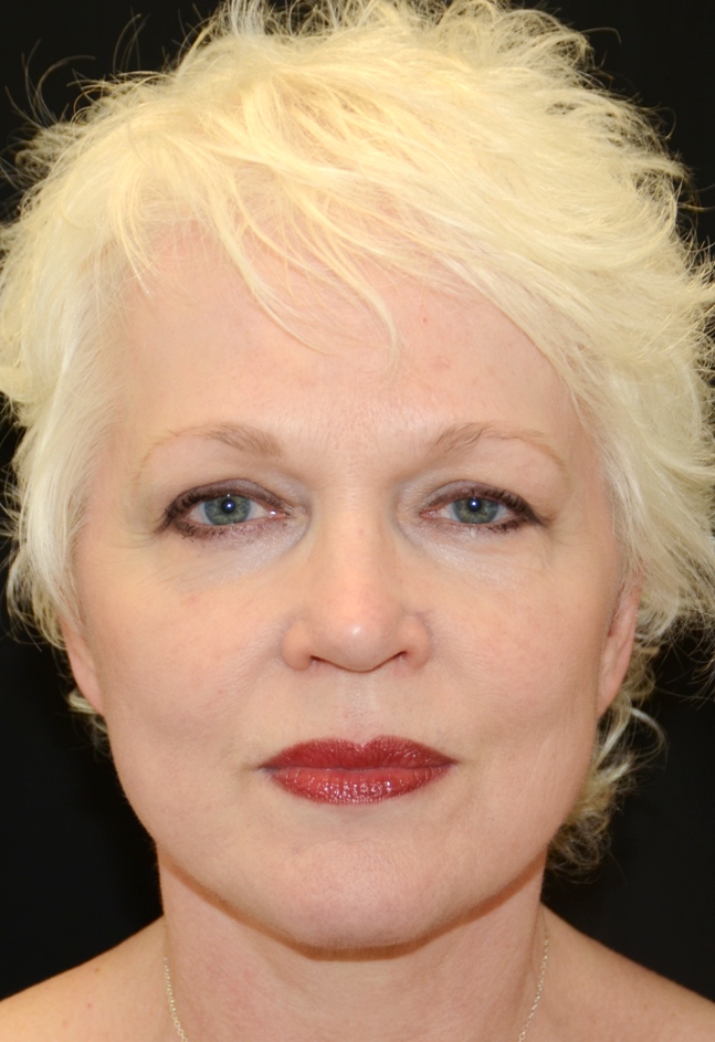 Facelift Los Angeles California