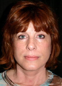 Facelift Los Angeles California