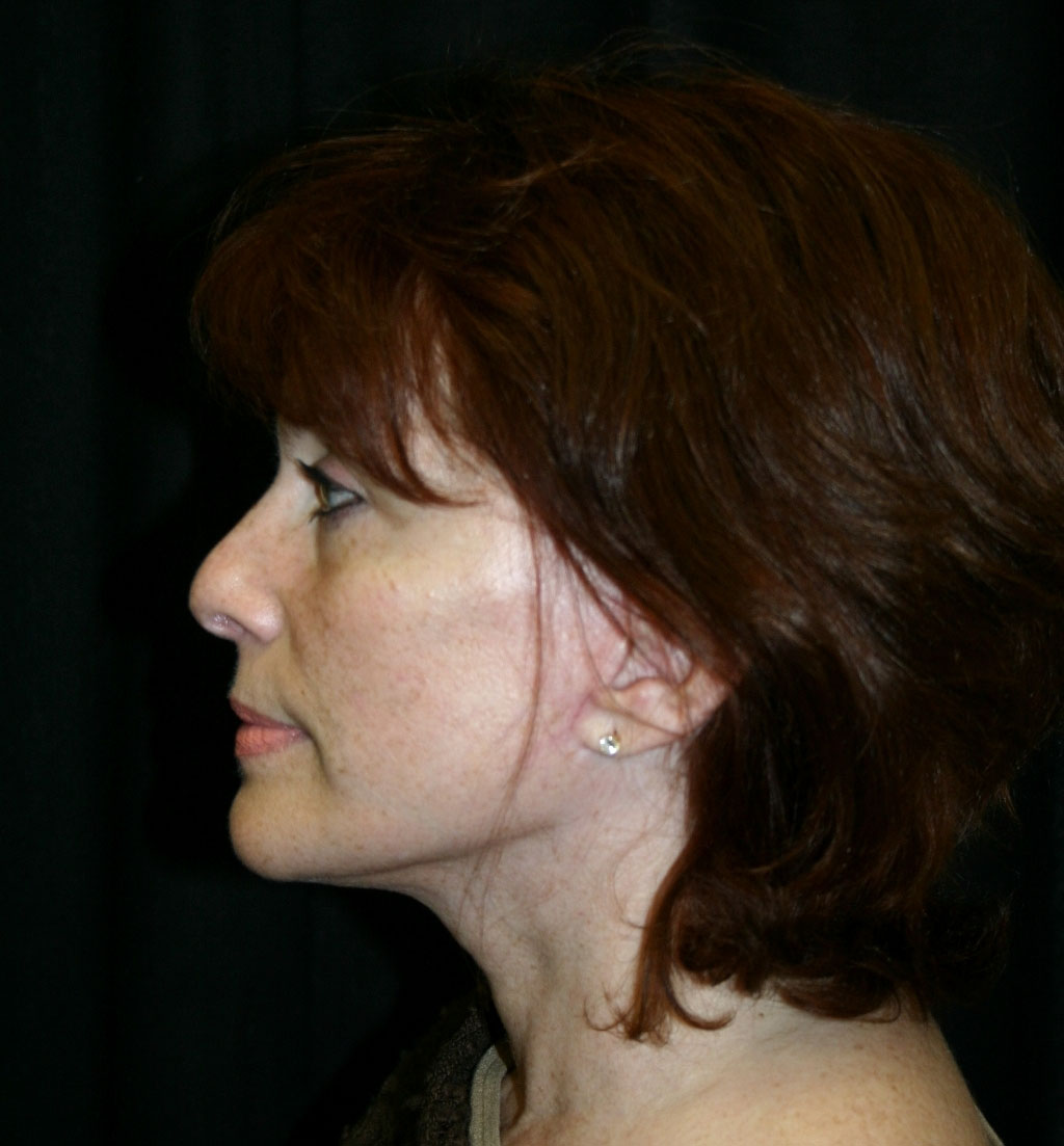 Facelift Los Angeles California