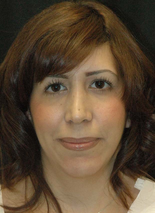 Rhinoplasty Los Angeles California