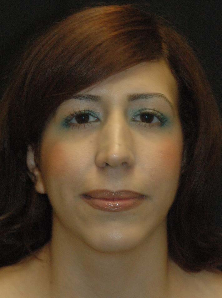 Rhinoplasty Los Angeles California