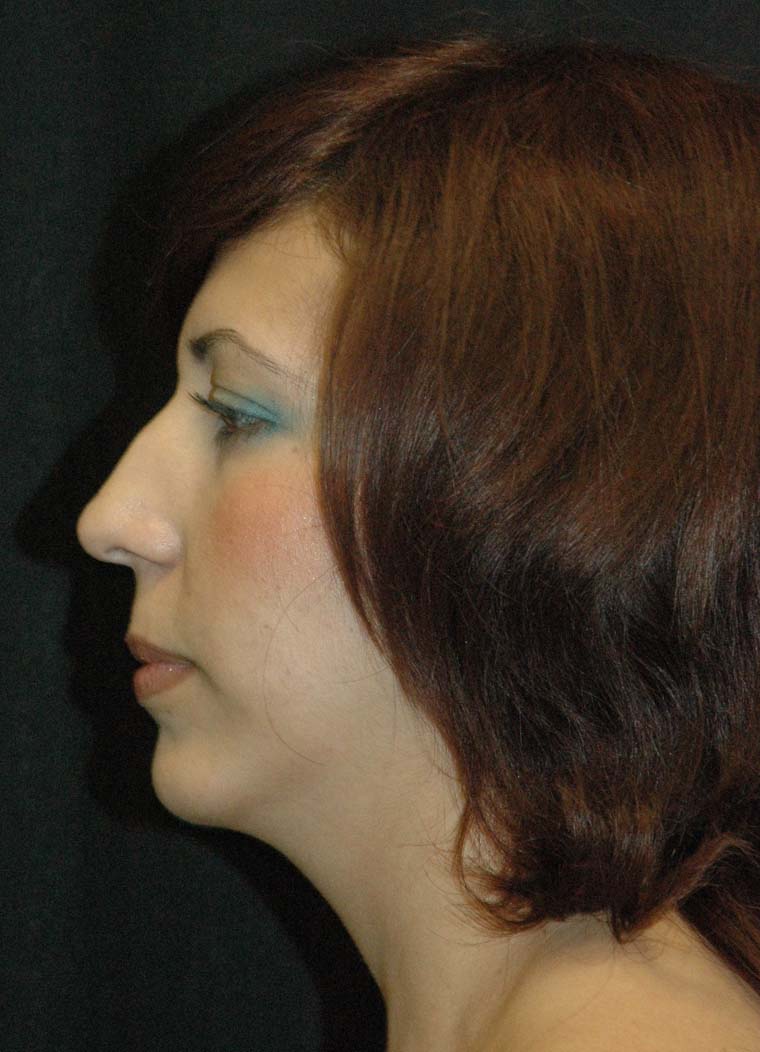 Rhinoplasty Los Angeles California