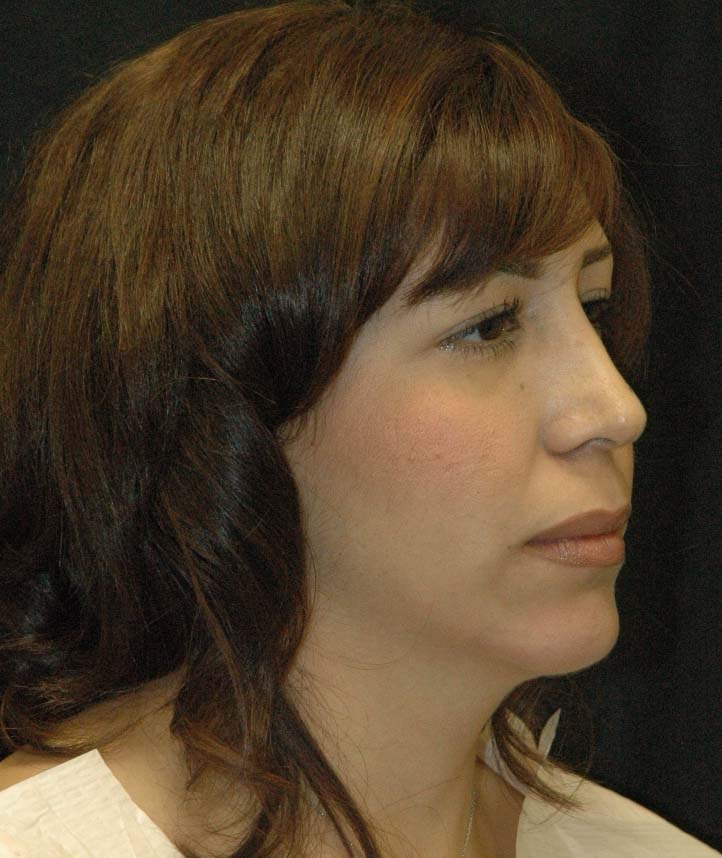 Rhinoplasty Los Angeles California