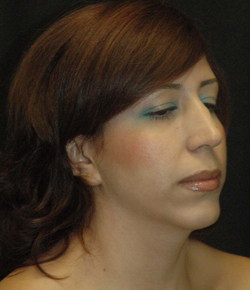 Rhinoplasty Los Angeles California