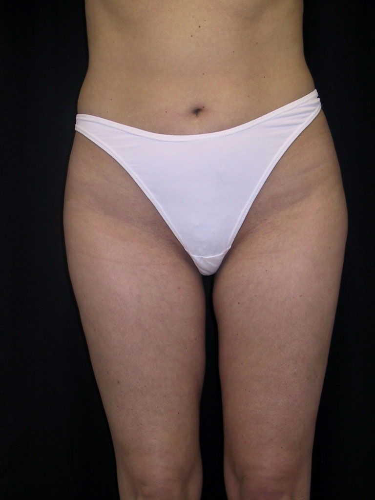 Liposculpture Los Angeles California