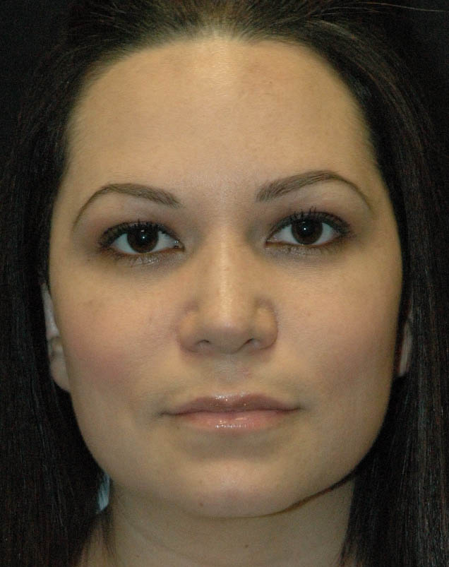 Rhinoplasty Los Angeles California