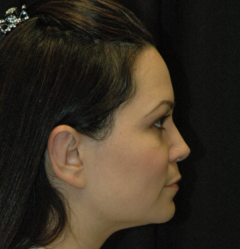 Rhinoplasty Los Angeles California