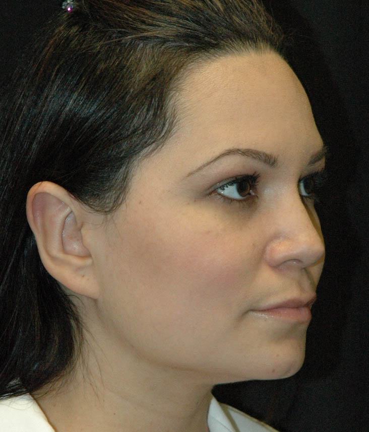 Rhinoplasty Los Angeles California