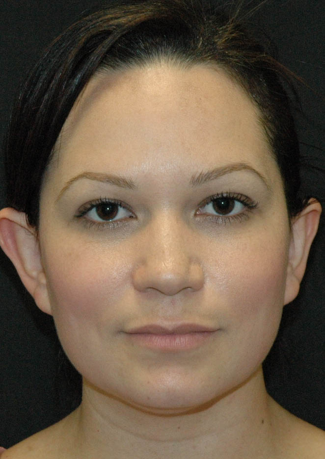 Rhinoplasty Los Angeles California
