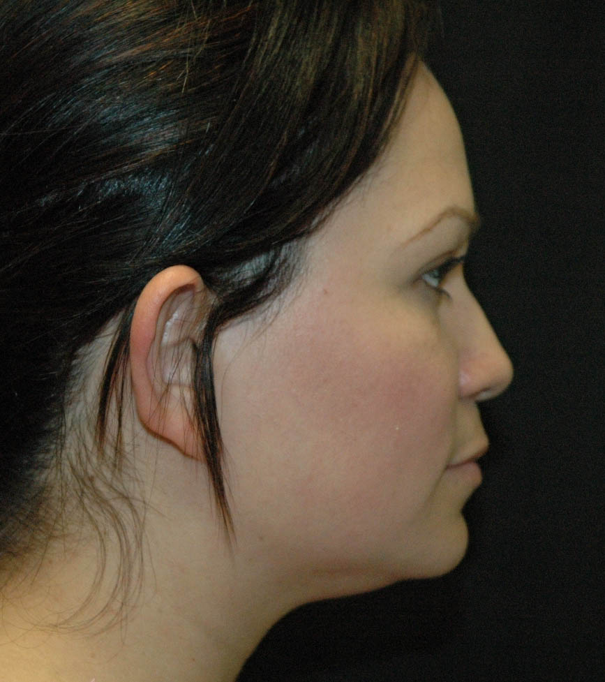 Rhinoplasty Los Angeles California