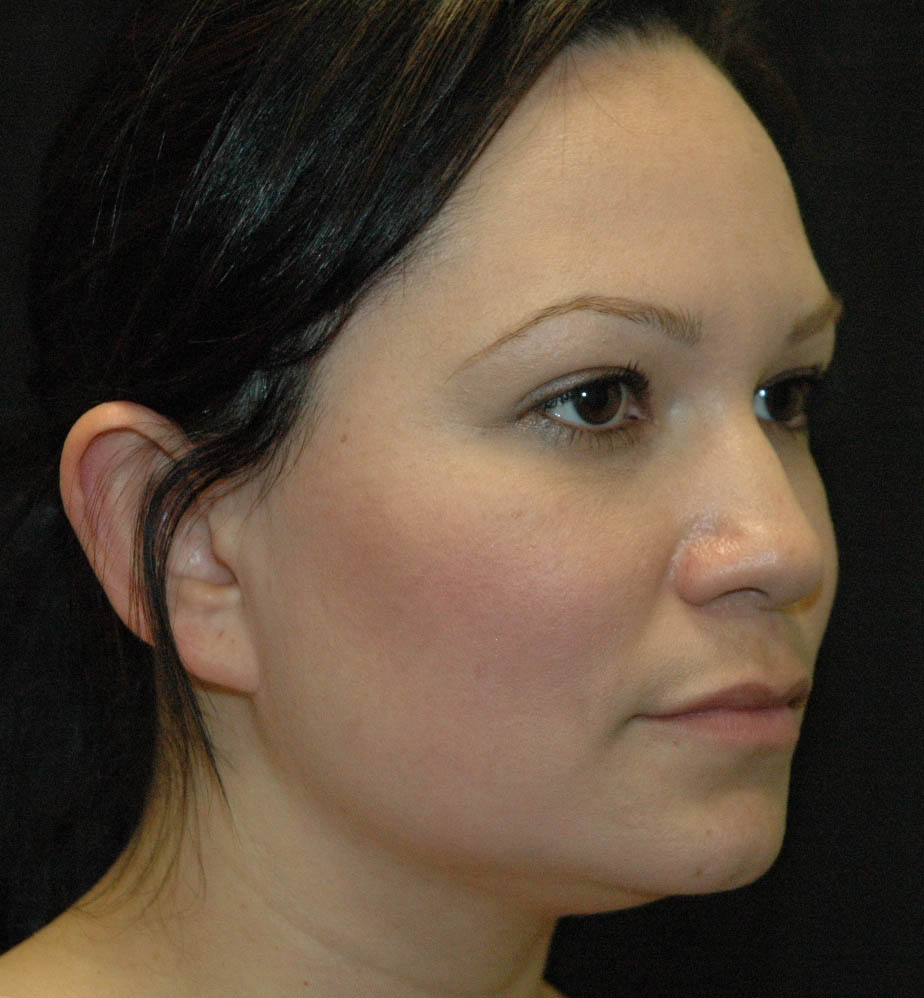 Rhinoplasty Los Angeles California