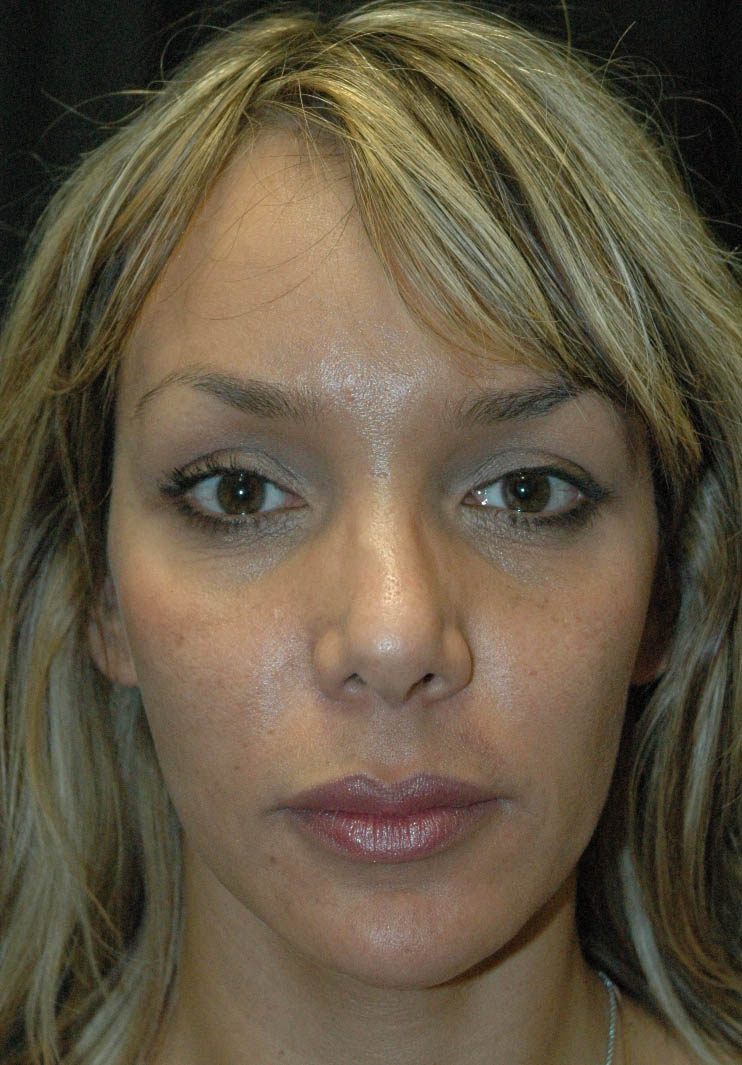 Rhinoplasty Los Angeles California