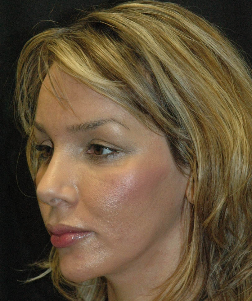 Rhinoplasty Los Angeles California