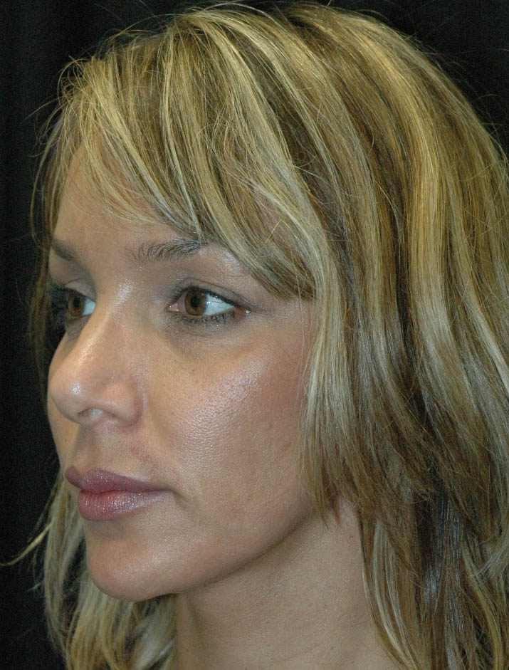 Rhinoplasty Los Angeles California