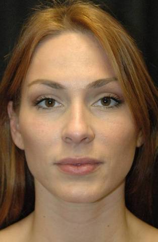 Rhinoplasty Los Angeles California