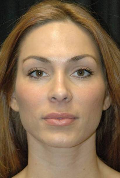 Rhinoplasty Los Angeles California