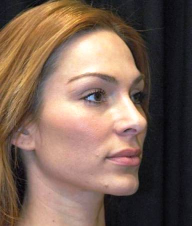 Rhinoplasty Los Angeles California