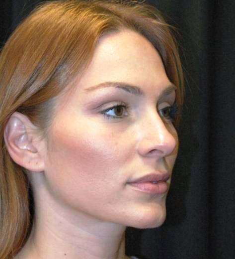 Rhinoplasty Los Angeles California