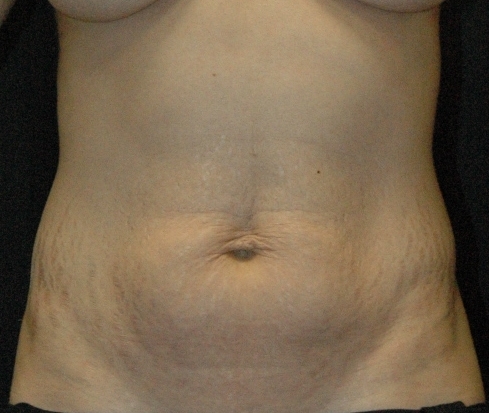 Tummy Tuck Los Angeles California